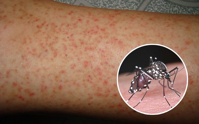 CHỦ ĐỘNG PHÒNG CHỐNG SỐT XUẤT HUYẾT – BẢO VỆ SỨC KHỎE CỘNG ĐỒNG